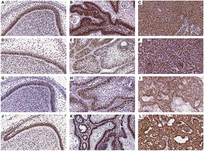 Expression of DNMTs and H3K9ac in Ameloblastoma and Ameloblastic Carcinoma